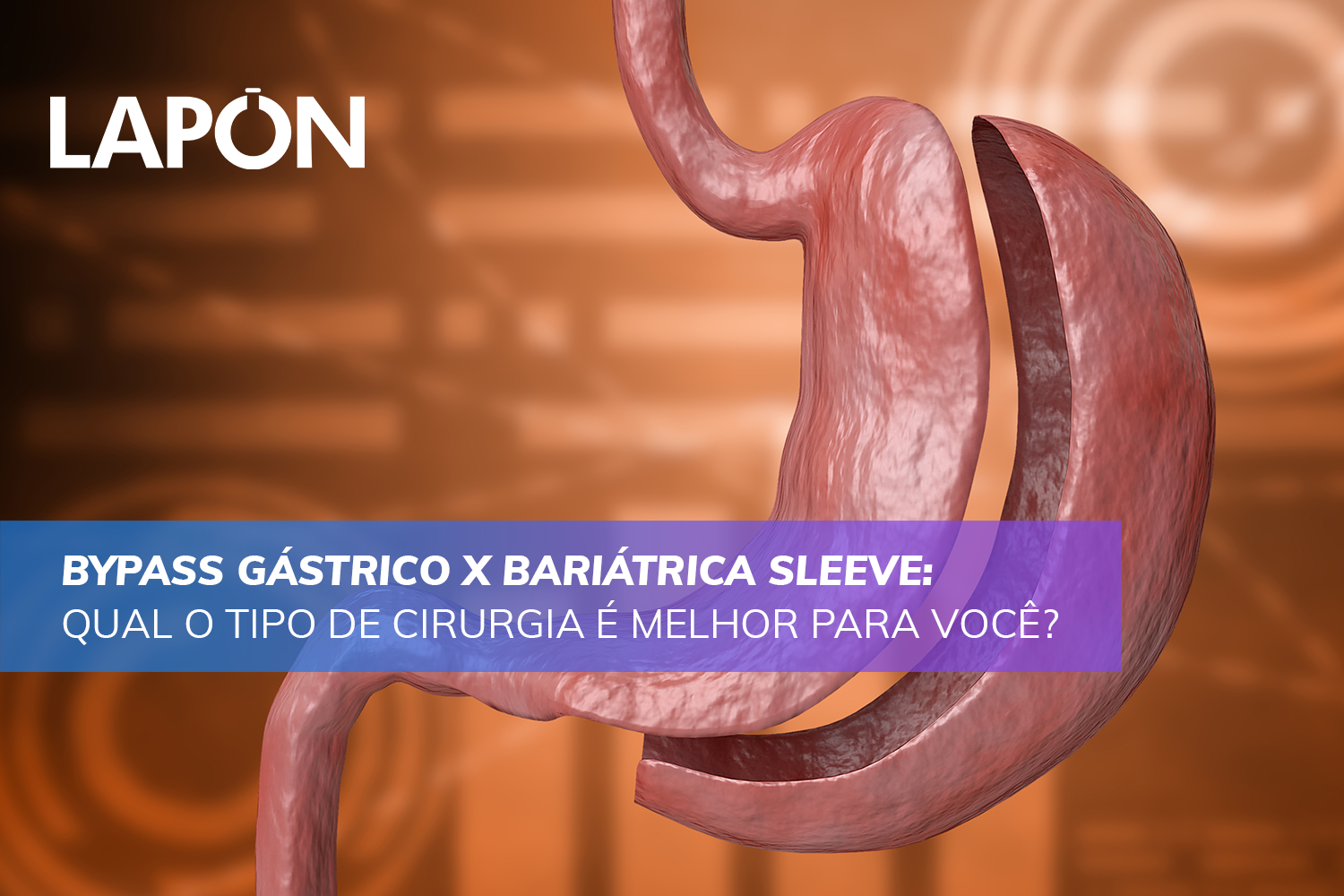 Bypass Gástrico X Bariátrica Sleeve: Qual é o melhor tipo?